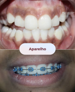 Aparelho