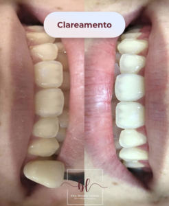 Clareamento