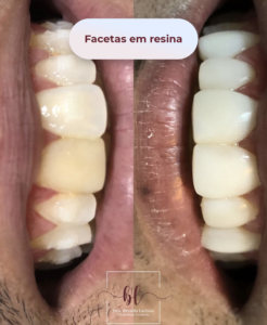 Facetas em resina